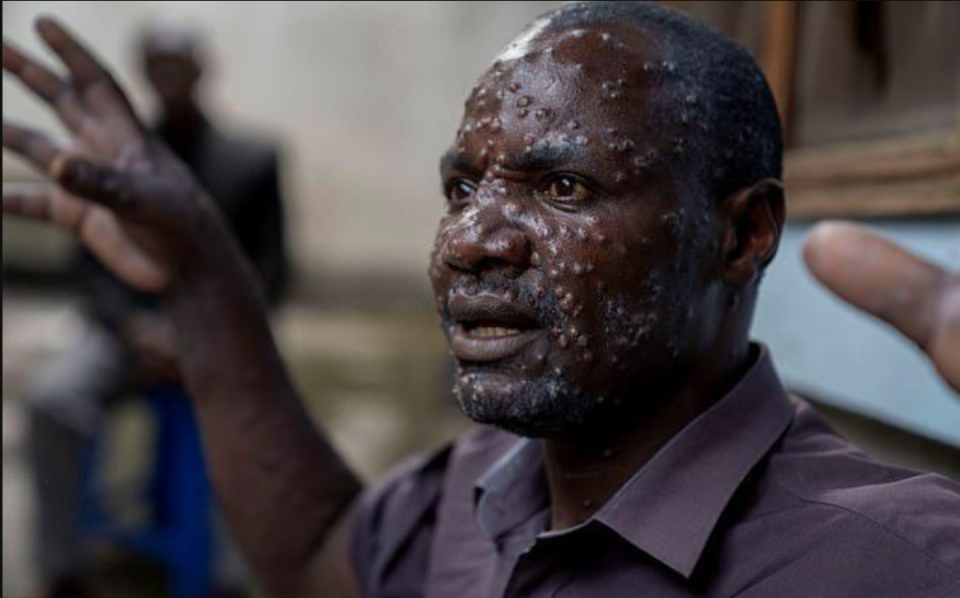 中国大陆猴痘病例已达10例(猴痘中国有多少人感染了)