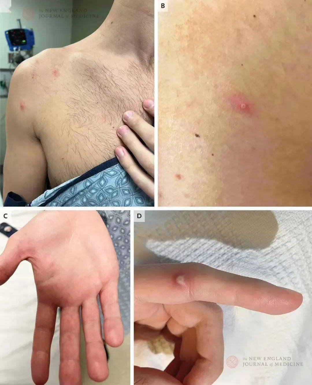 中国内地猴痘病例已增至57例(中国内地猴痘病例已增至57例了吗) 中国内地猴痘病例已增至57例(中国内地猴痘病例已增至57例了吗)